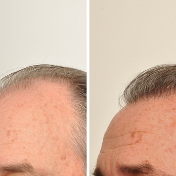 HairCareMD - 6 months following hair transplant - oblique view - Hair Loss Centers Near Me - New York, New York HairCareMD - 6 months following hair transplant - oblique view - Hair Loss Centers Near Me - New York, New York
