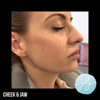 Jenna L Goldsmith - Cheek and jaw - Medical Spas Near Me - Williamsville, New York