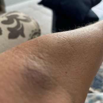 Labcorp - Blew this one too! No blood just pain. - Laboratory Testing Near Me - Mission Viejo, California Labcorp - Blew this one too! No blood just pain. - Laboratory Testing Near Me - Mission Viejo, California