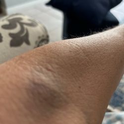 Labcorp - Blew this one too! No blood just pain.