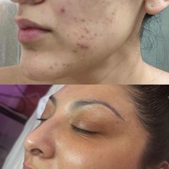 No Filter Beauty - Before & After - Skin Care Near Me - Albuquerque, New Mexico No Filter Beauty - Before & After - Skin Care Near Me - Albuquerque, New Mexico