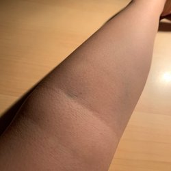 Quest Diagnostics - Bruiseless, painless, bloodwork