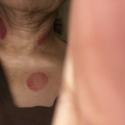 Acumedic Centre - This is the neck treatment I got for cough, ...