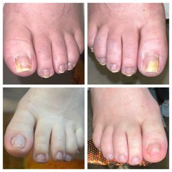 Nails by Luisa Advanced Nail Solution - Onychomycosis infection,