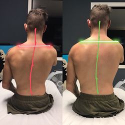 Myobolic Therapy - Before and after 60 min treatment for spinal and shoulder girdle alignment