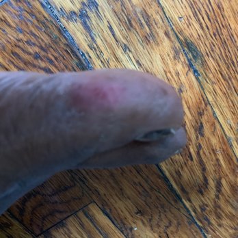 Wellzen Lounge - Look how sore and red the toe is!!! - Nail Salons Near Me - Brooklyn, New York