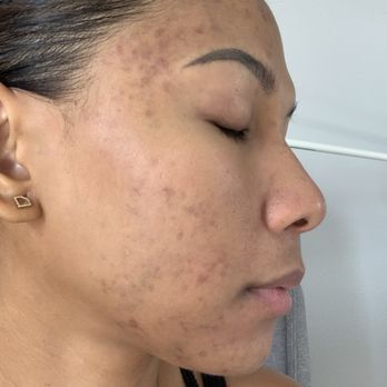 AWESTHETICS - A month after Amy did my first facial. - Skin Care Near Me - Huntington Beach, California AWESTHETICS - A month after Amy did my first facial. - Skin Care Near Me - Huntington Beach, California