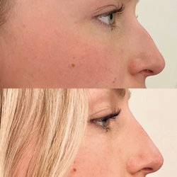 The Face Lab - Before & After Liquid Rhinoplasty