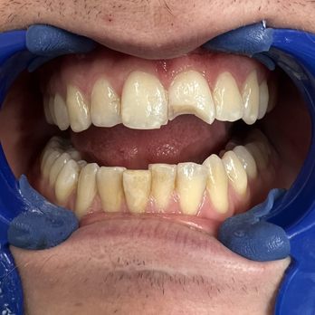 Valley Dental Group - Fractured front tooth - Orthodontists Near Me - Ramsey, New Jersey Valley Dental Group - Fractured front tooth - Orthodontists Near Me - Ramsey, New Jersey