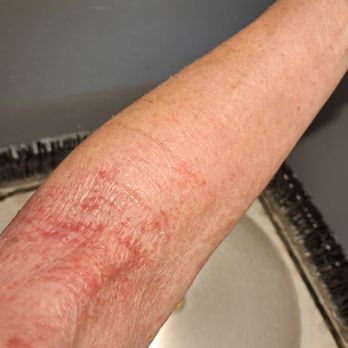 Queen Creek Naturopathic - This photo was taken 8 days after the appt.  I'd been on Prednisone for 3 weeks, which "cures" nothing.... - Naturopathic/Holistic Near Me - Queen Creek, Arizona