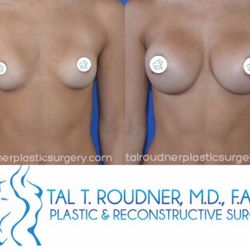 Tal T. Roudner, MD, FACS - Breast Augmentation