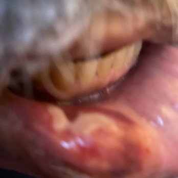 The Downey Dentist - The inside of my husband's lip after his visit on Monday - General Dentistry Near Me - Downey, California The Downey Dentist - The inside of my husband's lip after his visit on Monday - General Dentistry Near Me - Downey, California