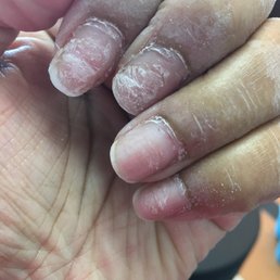 Nails ripped off Nails ripped off