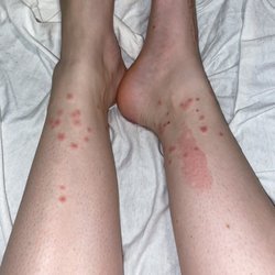 Stagecoach Stop Western Resort/Cowboy Creek Lodge - Bed bug bites from the bed I slept in