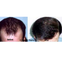 Steven B. Hopping, MD - Hair Transplant