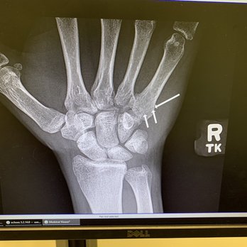 Steve A Mora, MD, FAAOS - Hand X-Ray - Sports Medicine Near Me - Orange, California Steve A Mora, MD, FAAOS - Hand X-Ray - Sports Medicine Near Me - Orange, California