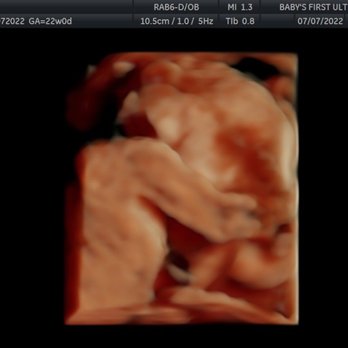 Baby's First Ultrasound - The "amazing pictures I got" lol - Diagnostic Imaging Near Me - Phoenix, Arizona