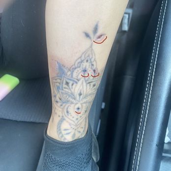 LaserAway - Tattoo Removal Near Me - Atlanta, Georgia