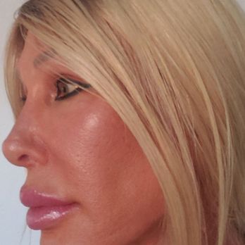 The Lanfranchi Center - Laser results - Plastic Surgeons Near Me - Las Vegas, Nevada The Lanfranchi Center - Laser results - Plastic Surgeons Near Me - Las Vegas, Nevada