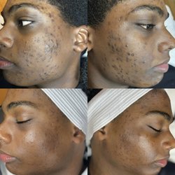 Beautopia Skin Studio - Acne program