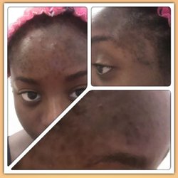 Estique - Before dermafile