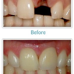 Tompkins Dental - Before and after a dental implant and crown