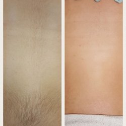 Aesthetic Beauty - Back wax before and after