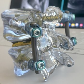 Achieve Brain & Spine - This the TOPS system he used. New technology. Allows much more movement than the old option which would be a whole bunch of fusion. - Spine Surgeons Near Me - Santa Monica, California Achieve Brain & Spine - This the TOPS system he used. New technology. Allows much more movement than the old option which would be a whole bunch of fusion. - Spine Surgeons Near Me - Santa Monica, California