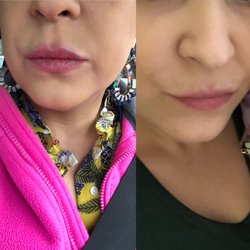 Hong Med Spa - Before(right) and after(left) lips fillers
