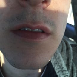 Bad shave. This is 25 mins after my shave here.