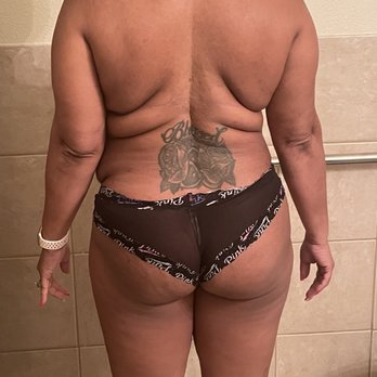 Dr Stile - Abdominoplasty Liposuction of the bra are gone wrong - Cosmetic Surgeons Near Me - Las Vegas, Nevada Dr Stile - Abdominoplasty Liposuction of the bra are gone wrong - Cosmetic Surgeons Near Me - Las Vegas, Nevada