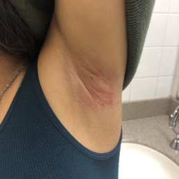 The rash The rash