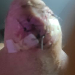 Advanced Foot & Ankle Care Specialists: Kennedy Legel, DPM - 2nd post op