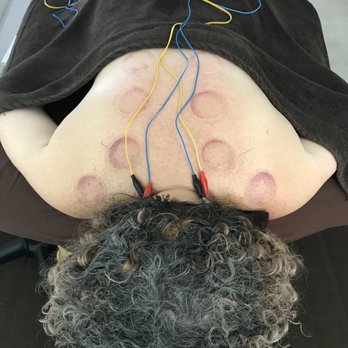 Blue Sky Acupuncture Studio - Me after cupping with needles. Btw this is most relaxing part of my week. - Acupuncture Near Me - Oakland, California Blue Sky Acupuncture Studio - Me after cupping with needles. Btw this is most relaxing part of my week. - Acupuncture Near Me - Oakland, California
