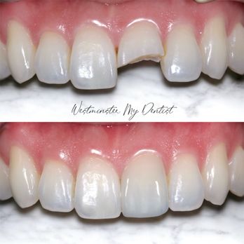 My Dentist - Discover how trauma can be restored to achieve natural esthetic and function in dentistry. - General Dentistry Near Me - Westminster, California My Dentist - Discover how trauma can be restored to achieve natural esthetic and function in dentistry. - General Dentistry Near Me - Westminster, California