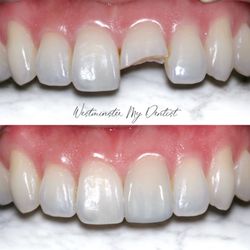 My Dentist - Discover how trauma can be restored to achieve natural esthetic and function in dentistry.