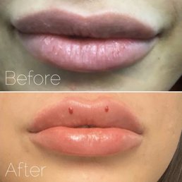 Lips, before and after