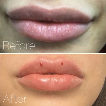 Daniel Moghadam , MD - Modern Aesthetica - Lips, before and after - Medical Spas Near Me - Beverly Hills, California