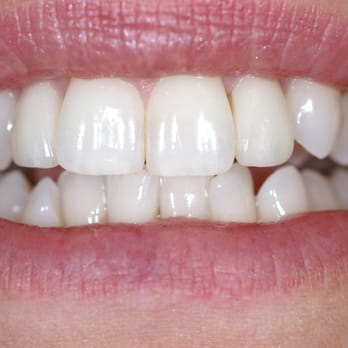 Windsor Park Dental Clinic - After - Cosmetic Dentists Near Me - Winnipeg, Manitoba Windsor Park Dental Clinic - After - Cosmetic Dentists Near Me - Winnipeg, Manitoba