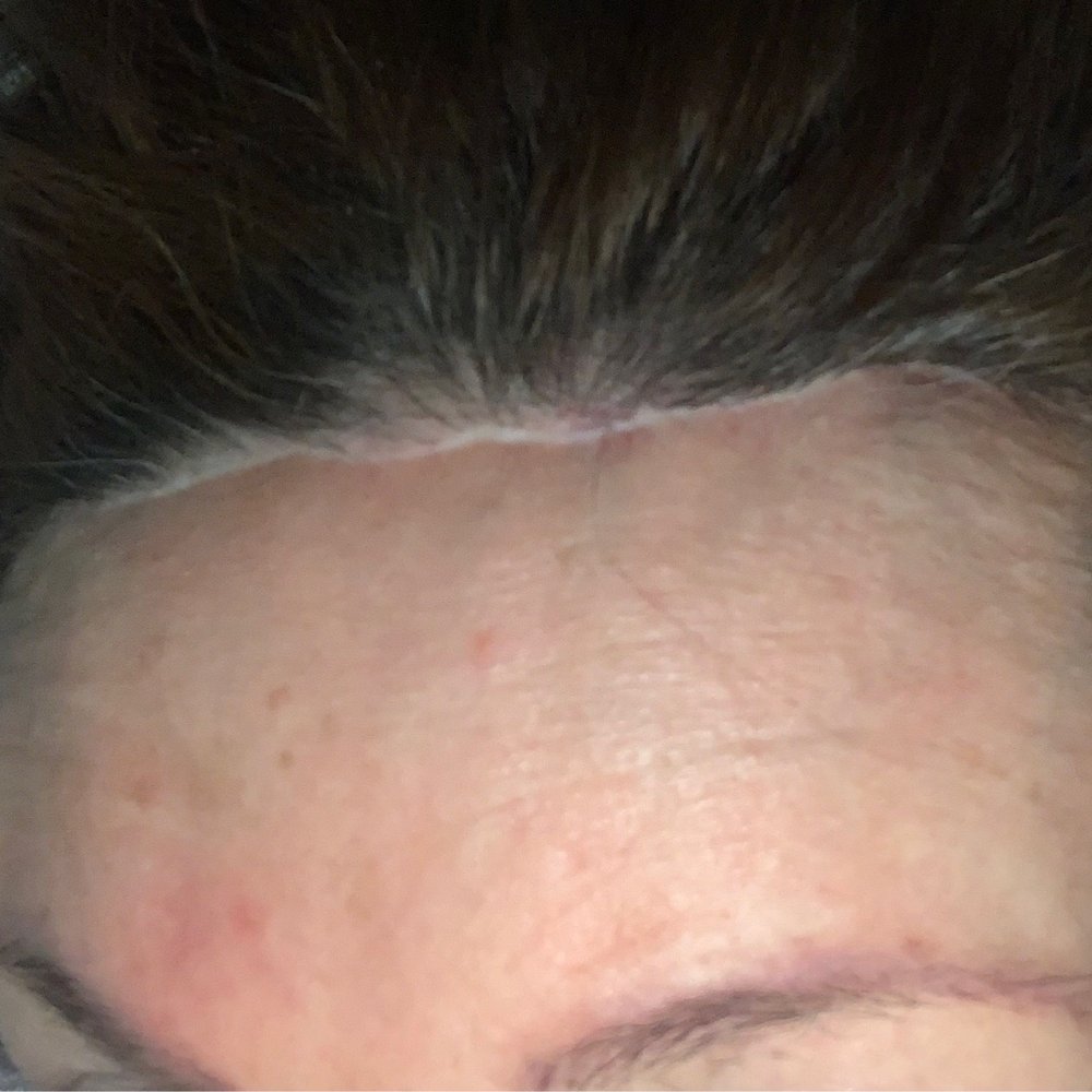 CosMed - Horrible Scars on the forehead from side to side! - Cosmetic Surgeons Near Me - Tijuana, BCN
