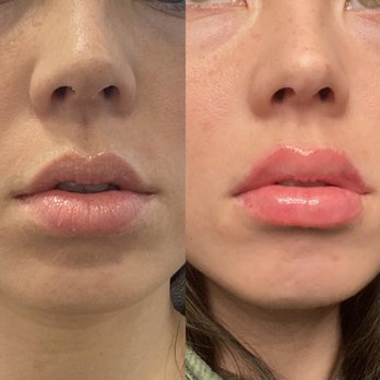 Pure Med Spa - Before and immediately after 1 cc lip filler - Medical Spas Near Me - Chicago, Illinois