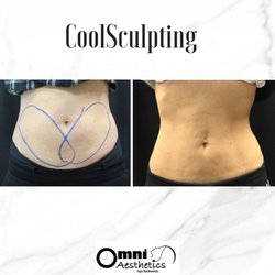 Omni Aesthetics - CoolSculpting before and after results. A non-surgical procedure with little to no downtime!