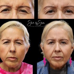 Stuck By Sticka - Botox between eyes