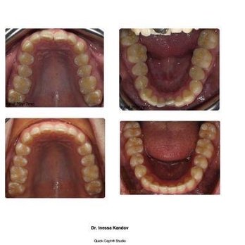 Bayside Family Dental, P.C. | Dr. Lev Kandov - Before/After Invisalign with Dr. Inessa Kandov! - General Dentistry Near Me - Bayside, New York Bayside Family Dental, P.C. | Dr. Lev Kandov - Before/After Invisalign with Dr. Inessa Kandov! - General Dentistry Near Me - Bayside, New York