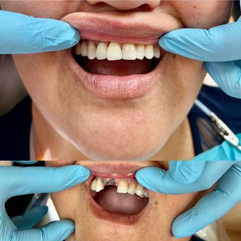 New World Dental - Dental Implants before and after (408)495-1257 - General Dentistry Near Me - Milpitas, California New World Dental - Dental Implants before and after (408)495-1257 - General Dentistry Near Me - Milpitas, California