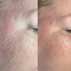 Superior Skin Aesthetics - 5 sessions of microneedle + recommended homecare