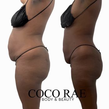 CoCo Rae Body & Beauty - Results after just ONE session of Herbal Ice Therapy! - Body Contouring Near Me - Hercules, California CoCo Rae Body & Beauty - Results after just ONE session of Herbal Ice Therapy! - Body Contouring Near Me - Hercules, California