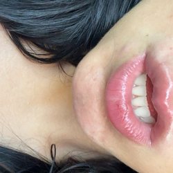 Arbor Dental - Busted lip