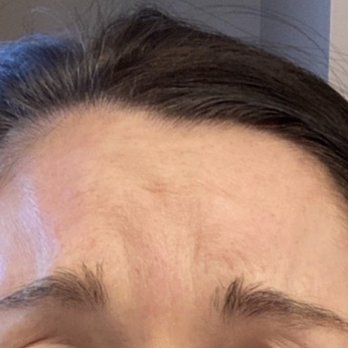 SpaDerma - 5 days after Botox - Medical Spas Near Me - Chicago, Illinois