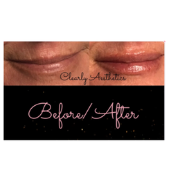 Clearly Aesthetics - Fillers